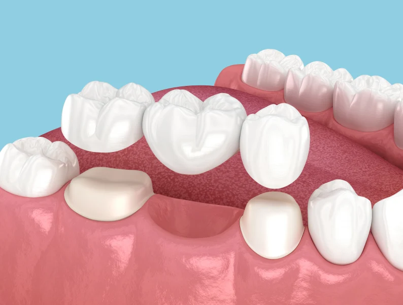 Common Challenges When Using Denture Services in Petersburg, VA