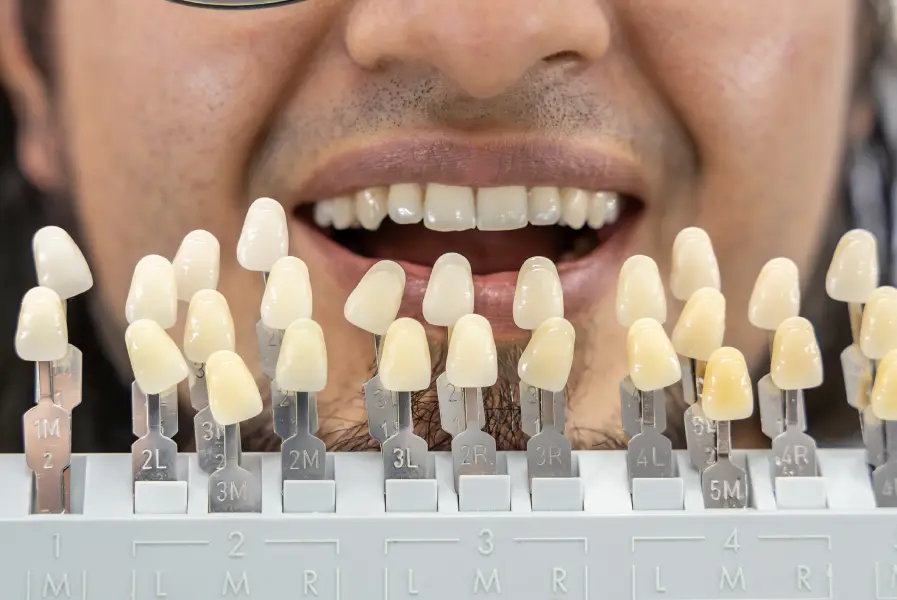 How Professional Teeth Whitening Services Brighten Smiles in Petersburg, VA