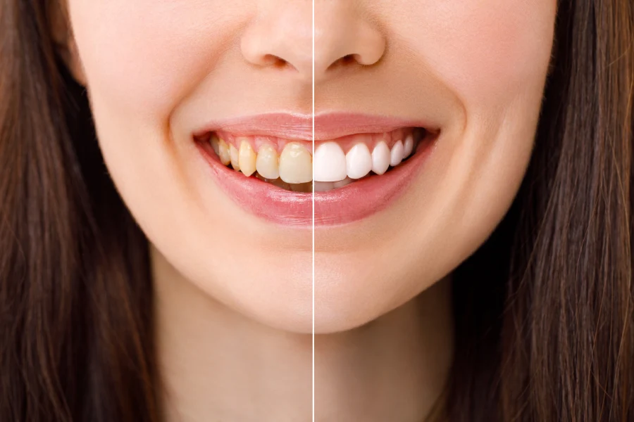 Understanding How Teeth Whitening Services Work Petersburg, VA